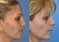rhinoplasty-right-side-VM-2021
