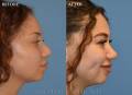 rhinoplasty-side-BA-2021-2