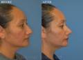 rhinoplasty-SV-side2