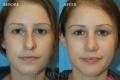rhinoplasty-2017-1