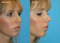 rhinoplasty-2017-2
