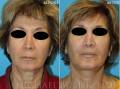face-necklift-front1