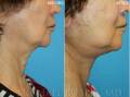 face-necklift-closeup1