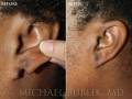 earlobe-repair-3
