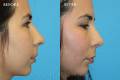 rhinoplasty-2017-3