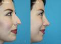rhinoplasty-2016-7
