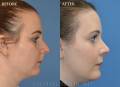 rhinoplasty-nm-right-side-2022-2
