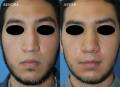 rhinoplasty-2018-1