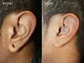 earlobe-repair-left-5