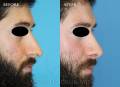 rhinoplasty-2018-3
