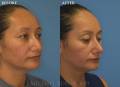 rhinoplasty-SV-oblique1