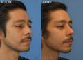 rhinoplasty-wb-2020-oblique
