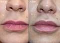 Lip lift before and after