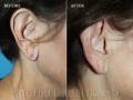 earlobe-repair2