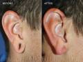 earlobe-repair-left-4