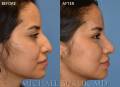 rhinoplasty-ec-leteral-2021