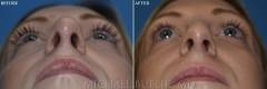 rhinoplasty-AP-2022-base-view