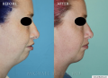 liposuction-chin
