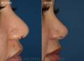 rhinoplasty-closeup-BA-2021-4