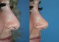 rhinoplasty-dec-2018-side