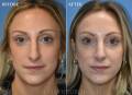 rhinoplasty-AP-2022-front