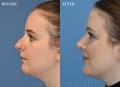 rhinoplasty-nm-left-side-2022-4